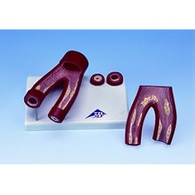 Arteriosclerosis Model, with cross section of artery, 2 part by American 3B Scientific