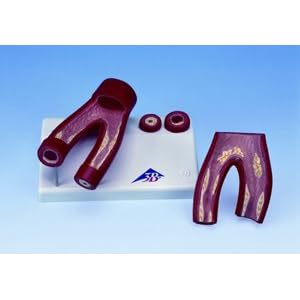 Arteriosclerosis Model, with cross section of artery, 2 part by American 3B Scientific