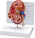 Oversize Diseased Kidney Anatomy Model with Patient Education Card