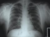Chest X-Ray Atelectasis Vs. Lung Infiltrate Photographic Poster Print, 40x30