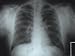 Chest X-Ray Atelectasis Vs. Lung Infiltrate Photographic Poster Print, 16x12