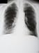 Chest X-Ray Post Operative Mastectomy Photographic Poster Print, 12x16