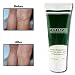 Vein Eraser Cream