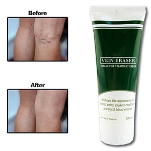 varicose vein treatment