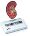 kidney stones - 3B Scientific Kidney Stone Model; With Kidney Stones; Life-Size; Dim.: 14 x 10 x 16.5cm