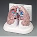 Diseased Lung Model