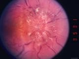 Papilledema Retinopathy Photographic Poster Print, 24x18