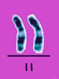 Chromosome 11 Gene Therapy Sickle Cell Anemia Photographic Poster Print, 24x32
