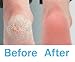Pursonic CR360 Battery Operated Callus Remover Pedi Perfect Foot File, 2 Roller Heads Included