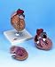 Classic Heart Model with Left Ventricular Hypertrophy (LVH), 2 part