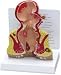 Rectum Anatomy Model - Shows various diseases of the rectum