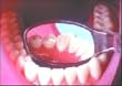 Pulpdent Flecta Disposable Mirror 200/bx - Model Flec