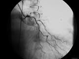 Cardiac Cath, 90% Stenosis Main Coronary Artery Photographic Poster Print, 40x30