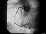 Cardiac Cath, Angiogram Normal Rt. Coronary Artery Photographic Poster Print, 24x32