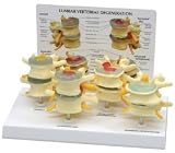 Anatomical 4-stage Osteoporosis Vertebrae Model