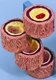 Anatomical Artery Cholesterol Atherosclerosis - Progressively Clogged