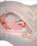 Amniotic Fluid Tutor, Online or CD-ROM (Tutor)