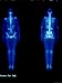 Technetium 99 Nuclear Med Bone Scan Whole Body Photographic Poster Print, 12x16