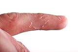 31zgQGrrX0L. SL160  Closeup of Eczema on Male Finger with Skin Peeling   24W x 16H   Peel and Stick Wall Decal by Wallmonkeys Reviews