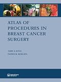 Atlas of Procedures in Breast Cancer Surgery