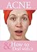 Acne and How to Deal With It Acne and How to Deal With It
