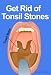 Get Rid of Tonsil Stones - Causes, Symptoms, Treatment, Removal and Other Remedies (Health Information and Tips) Get Rid of Tonsil Stones - Causes, Symptoms, Treatment, Removal and Other Remedies (Health Information and Tips)