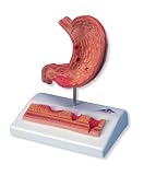 3B Scientific Stomach with Ulcers