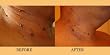 Dermatend The Original Mole, Wart & Skin Tag Remover Natural At Home Removal System. Removing Moles, Warts & Skin Tags Has Never Been Easier.