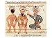 Cauterisation of Leprosy Lesions, 1466 Art Giclee Poster Print by Charaf-ed-din, 12x9