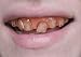 Hillbilly Grillz Teeth Adult