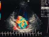 Doppler Echocardiogram. Ultrasound Tricuspid Regur Photographic Poster Print, 40x30