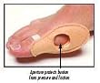`Bunion Shield Universal