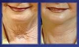 16 Eyebrow Lifts & 16 Neck Lifts (catalog copy error)