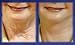 16 Eyebrow Lifts & 16 Neck Lifts (catalog copy error)