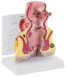 Anatomical Human Rectum Cancer Model