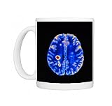 Col. MRI scan of a brain with multiple sclerosis Photo Mugs