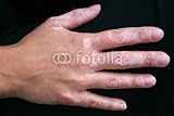 Wallmonkeys Peel and Stick Wall Decals - A Hand with Vitiligo Skin Condition - 24"W x 16"H Removable Graphic