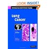 Lung Cancer (Contemporary Issues in Cancer Imaging)