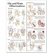 Hip and Knee Inflammations Anatomical Chart 2nd Edition