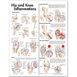 Hip and Knee Inflammations Anatomical Chart 2nd Edition