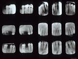 15 Dental X-Rays Photographic Poster Print, 24×18