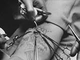 Doctors at Ohio State Removing Growth of Pre Injected Cancerous Cells from Prisoner's Arm Photographic Poster Print by Peter Stackpole, 40x30