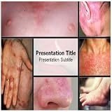 414zvHtHvuL. SL160  Erythema PowerPoint Template   Erythema PowerPoint (PPT) Themes Templates Reviews