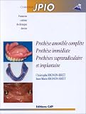 Proth�se amovible compl�te - Proth�se imm�diate - Proth�ses supraradiculaire et implantaire