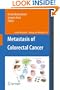 Metastasis of Colorectal Cancer (Cancer Metastasis - Biology and Treatment)