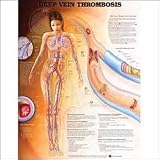 Deep Vein Thrombosis Anatomical Chart Unmounted