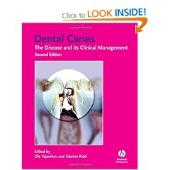 Dental Caries: The Disease and Its Clinical Management