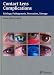 Contact Lens Complications