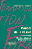 Cancer de la vessie