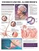Anatomical Charts - Alzheimers . Flexible lamination with metal eyelets in each top corner for convenient wall hanging. . Markable (write-on/write-off surface). . Available size: 20&rdquo;W x 26&rdquo;H.